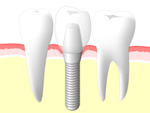 インプラント